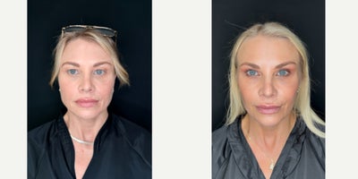 Eyelid Surgery before and after photo