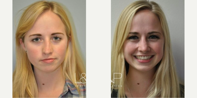 Rhinoplasty before and after photo