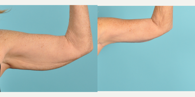Arm Lift before and after photo