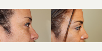 Eyelid Surgery before and after photo