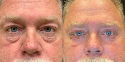 Eyelid Surgery before and after photo