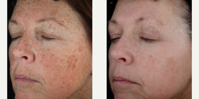 IPL before and after photo