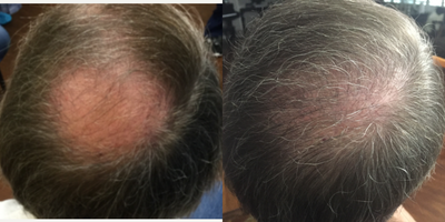 NeoGraft before and after photo