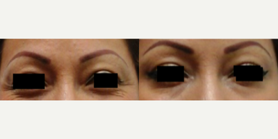 Botox before and after photo