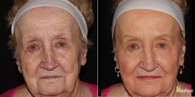 Radiesse before and after photo