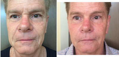 Bellafill before and after photo