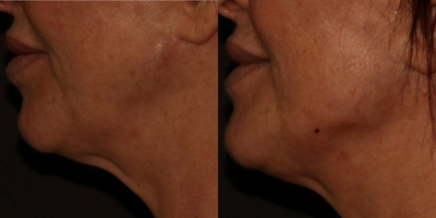Dermal Fillers before and after photo