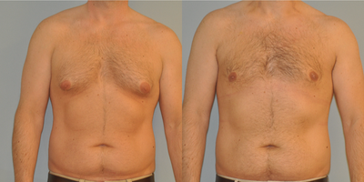Gynecomastia Surgery before and after photo