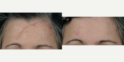 Scar Removal before and after photo