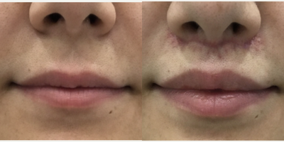 Lip Lift before and after photo