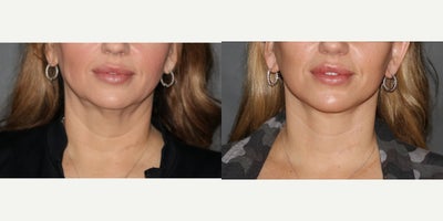 Neck Lift before and after photo