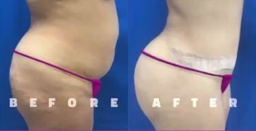 Tummy Tuck before and after photo