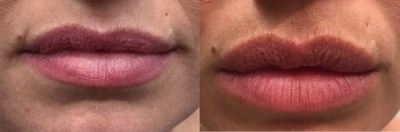 Dermal Fillers before and after photo