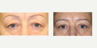 Eyelid Surgery before and after photo