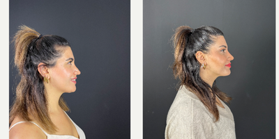 Revision Rhinoplasty before and after photo