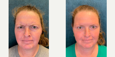 Dysport before and after photo