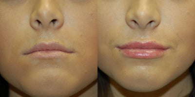Lip Fillers before and after photo