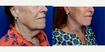 Neck Lift before and after photo