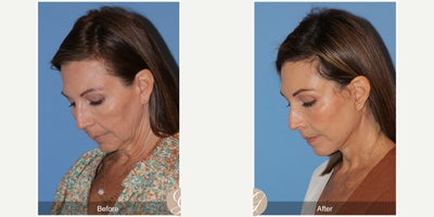 Buccal Fat Removal before and after photo
