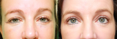 Eyelid Surgery before and after photo
