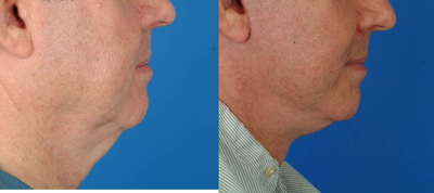 Facelift before and after photo