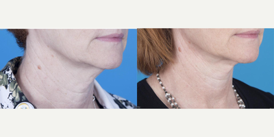 Neck Lift before and after photo