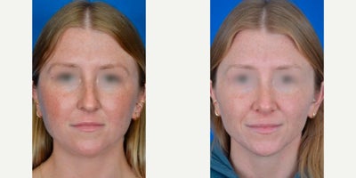 Rhinoplasty before and after photo
