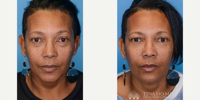 Double Eyelid Surgery before and after photo