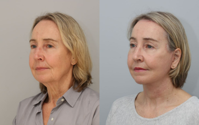 Facelift before and after photo