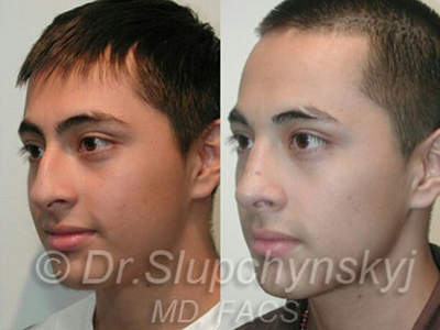Rhinoplasty before and after photo
