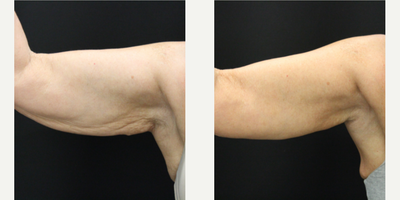 Arm Lift before and after photo