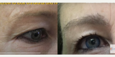 Eyebrow Transplant before and after photo