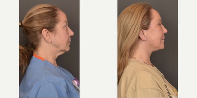 Eyelid Surgery before and after photo