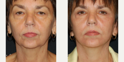 Facelift before and after photo