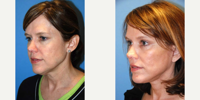 Neck Lift before and after photo