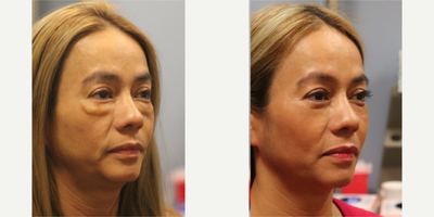Restylane before and after photo