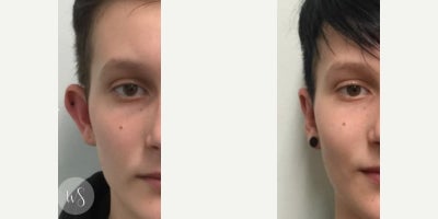 Earfold before and after photo