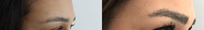 Eyebrow Transplant before and after photo