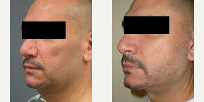 Facelift before and after photo