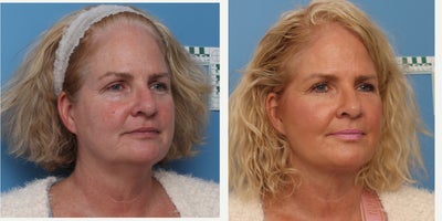 Facelift before and after photo
