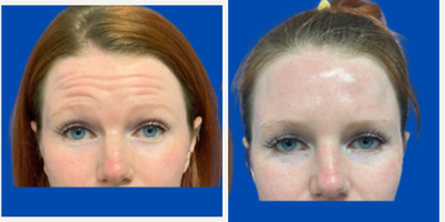Botox before and after photo
