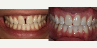 Braces before and after photo
