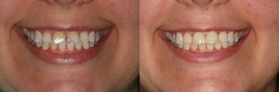 Dental Crown before and after photo