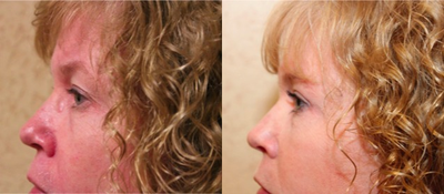 Eyelid Surgery before and after photo