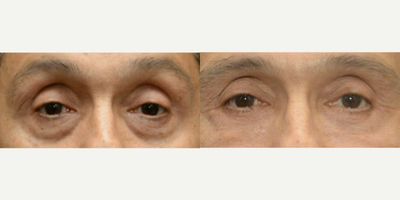 Eyelid Surgery before and after photo
