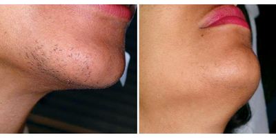 Laser Hair Removal before and after photo