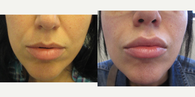 Lip Fillers before and after photo