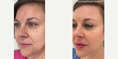 Bellafill before and after photo