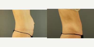 Drainless Tummy Tuck before and after photo