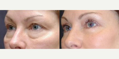 Eyelid Surgery before and after photo